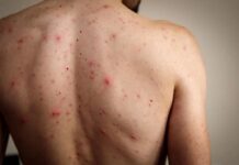 México encabeza mortalidad por sarampión en América; OMS alerta brote crítico