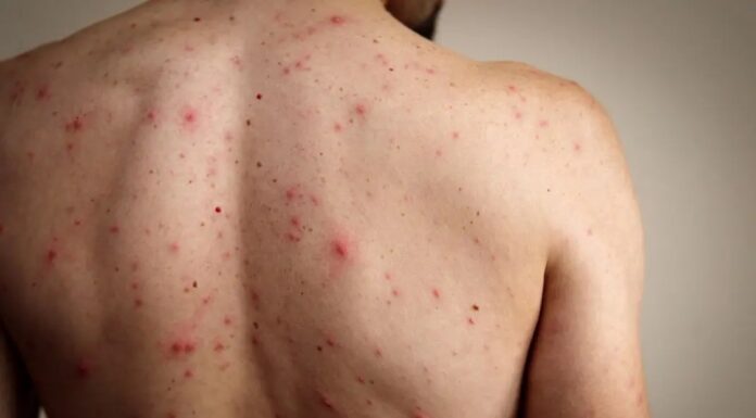 México encabeza mortalidad por sarampión en América; OMS alerta brote crítico