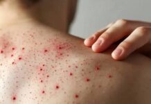 Alerta sanitaria en México: sarampión sigue en ascenso y Estado de México refuerza medidas