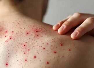 Alerta sanitaria en México: sarampión sigue en ascenso y Estado de México refuerza medidas